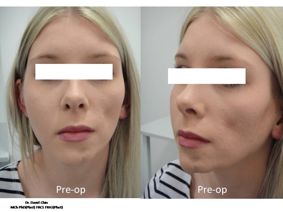 Parry-Rombergs Syndrome-surgery-brisbane